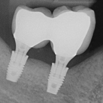 Impianti osteo-integrati con ricostruzione ossea