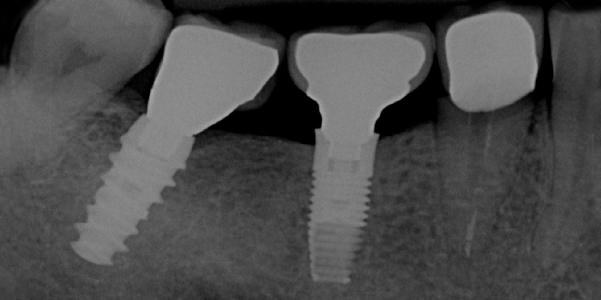 Implantologia ossea avanzata, Impianti con rigenerazione ossea