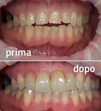 Ricostruzione Denti con Faccette in ceramica - Protesi Dentarie